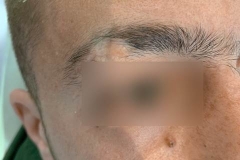 Διόρθωση Ουλής μετά απο τραυματισμό-Δερματοχειρουργική