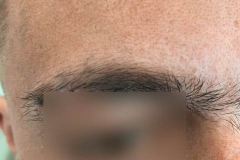 Διόρθωση Ουλής μετά απο τραυματισμό-Δερματοχειρουργική