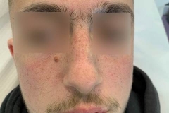 Διόρθωση Ουλής μετά απο τραυματισμό-Δερματοχειρουργική
