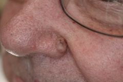 Επιθηλίωμα στο πτερύγιο μύτης-κρυοθεραπεία